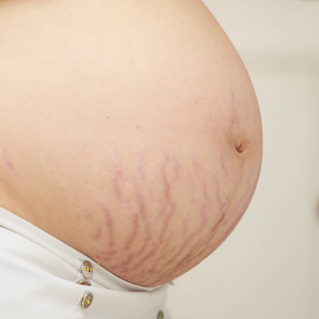 A pregnant belly with visible stretch marks